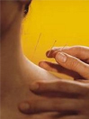 Therapies . acupuncture_treatment